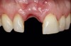 (26.) Facial and occlusal views of the soft-tissue contour achieved after 3 months of provisionalization. The tissue is thick with a harmonious gingival contour and zenith position.