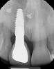 (29.) Facial view and radiograph of the final implant-supported crown.
