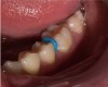 Fig 1.  Circumferential gumline decalcification (Fig 1) and bitewing (Fig 2) of a 28-year-old woman.