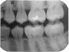 Fig 2.  Circumferential gumline decalcification (Fig 1) and bitewing (Fig 2) of a 28-year-old woman.