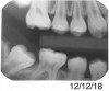 Fig 14. Same patient more than 3 years later.