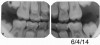 Fig 15. Bitewing of an 11-year-old boy.