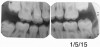 Fig 16. Same patient several months later.