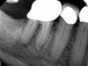 (1.) A 74-year-old male presented with an acute apical abscess associated with tooth No. 30. The pre-operative periapical x-ray revealed evidence of apical pathology.