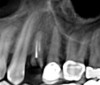 (3.) CBCT scan of tooth No. 12, exhibiting a retained root that previously received root canal treatment.