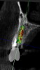 (4.) Digital plan of the virtual implant.