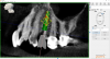 (5.) Digital plan of the virtual implant.