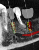 (9.) Virtual plan showing that the extraction of tooth No. 20 followed by robot-assisted immediate implant placement at the sites of teeth Nos. 19 and 21 was a viable option.