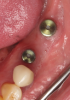 (14.) Three-month postoperative occlusal and buccal views of the healed implants at site Nos. 19 and 21.