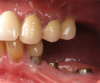 (15.) Three-month postoperative occlusal and buccal views of the healed implants at site Nos. 19 and 21.