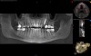 (7.) Postoperative CBCT images confirming implant placement according to the digital plan.