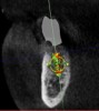 (11.) Implant position at site No. 21 optimized on the virtual plan.