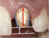 Fig 1. The most important factors to consider in preparing teeth for single-unit restorations are the taper, height, and reduction.