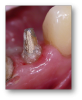 Fig 3. To increase resistance form, the ferrule should be at least 1.5 to 2.0 mm.