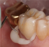 Fig 6. The most compatible final cement should be matched with the type of ceramic crown.