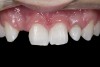 (2.) After orthodontic alignment of teeth and bleaching. Note alveolar deficiency in right lateral incisor site and diminutive left lateral incisor.