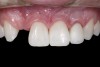 (3.) After resin-based composite bonding of the three incisors.