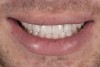 (11.) Smile view, 14 days after exposure of implant.