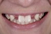 (12.) 15-year-old girl after orthodontic therapy idealized maxillary lateral incisor spaces.
