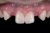 (13.) Deficient ridges in the areas of the missing lateral incisors.