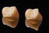 (2.) Full-contoured monolithic zirconia crown (left) and monolithic zirconia crown with facial cutback design (right) after milling.