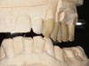 (6.) All-ceramic, bilayered fixed dental prostheses with occlusal contacts on zirconia in maximum intercuspation position and excursive movements.