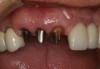 (7.) Stump shades should be communicated using a stump shade guide when restoring teeth with all-ceramic restorations.