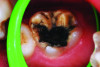 (1.) Hypocalcified/carious first molar, 12 months after SDF application.