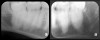 Fig 5. Bilateral concerns for this patient are evident on these PSP
radiographs. Tooth No. 17 may exhibit pathology distal to the root. In
addition, extreme length of root of tooth No. 32 through the entire height
of the body of the mandible is cause for concern if extractions of Nos.
17 and 32 are planned. Three-dimensional CBCT study and alerts to
the patient as to the potential surgical complications on extractions are
required in this instance. There is no benefit to panoramic radiography
in this case.