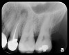 Fig 11. A PA
radiographic image showing PA pathosis associated with incomplete
endodontic obturation on tooth No. 13.