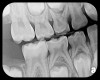 Fig 13. An easily placed pediatric
PSP no. 2 size right side BW radiograph shows the presence of second
molars and the normal pattern of eruption of the bicuspids in this patient,
age 7.