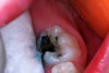 (4.) SDF treated molar in a 3-year-old patient, 4 months after application.