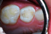 (6.) After exposure of disto-occlusal caries, SDF is applied, followed by a coating of fluoride varnish.
