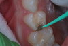 (8.) After exposure of disto-occlusal caries, SDF is applied, followed by a coating of fluoride varnish.