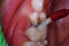 (9.) After exposure of disto-occlusal caries, SDF is applied, followed by a coating of fluoride varnish.
