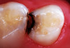 (10.) View of the treated tooth, 13 months after SDF application.