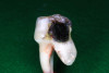 (11.) Views of sectioned primary molar that was extracted for orthodontic considerations 22 months after three SDF treatments that were each 6 months apart.