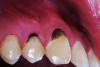 (15.) A 21-year-old patient returned for a second SDF/fluoride varnish treatment for cervical caries, 3 months after initial SDF application. The patient needed to delay restorative care for “personal reasons.”