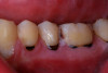(16.) A 21-year-old patient returned for a second SDF/fluoride varnish treatment for cervical caries, 3 months after initial SDF application. The patient needed to delay restorative care for “personal reasons.”
