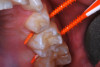 (17.) Soft dental picks used for proximal SDF application.