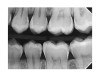 (18.) Radiograph of teenage patient showing maxillary left first premolar, which will be scheduled for disto-occlusal restoration, and all other proximal sites that will be treated with dental pick applied SDF. Additional application of SDF planned for 3 months and new bitewing films to be recorded in 6 months.
