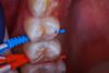 (19.) Example of SDF dental pick application in teenage patient.