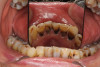 (25.) 68-year-old cancer patient who had complete xerostomia associated with his treatment. SDF attenuated multiple caries lesions. (Photographs courtesy of Dr. Scott Eidson).