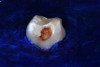 (26.) Silver modified atraumatic restorative technique (SMART) caries control treatment demonstrated on extracted carious primary molar.