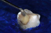 (31.) Silver modified atraumatic restorative technique (SMART) caries control treatment demonstrated on extracted carious primary molar.