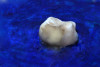 (32.) Silver modified atraumatic restorative technique (SMART) caries control treatment demonstrated on extracted carious primary molar.
