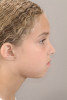 (5.) A 7-year-old girl who presented with mild convexity to her profile, lip incompetence, and a mild class II malocclusion.