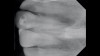 (3.) Case 1: Preoperative radiograph of the maxillary right central incisor, demonstrating periapical radiolucency and porous core buildup.