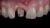 (5.) Case 1: Discolored stump and resin core immediately following sectioning and removal of the existing ceramic restoration.