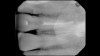 (7.) Case 1: Postoperative radiograph following endodontic therapy and the placement of an internal bleaching agent into the pulp chamber.